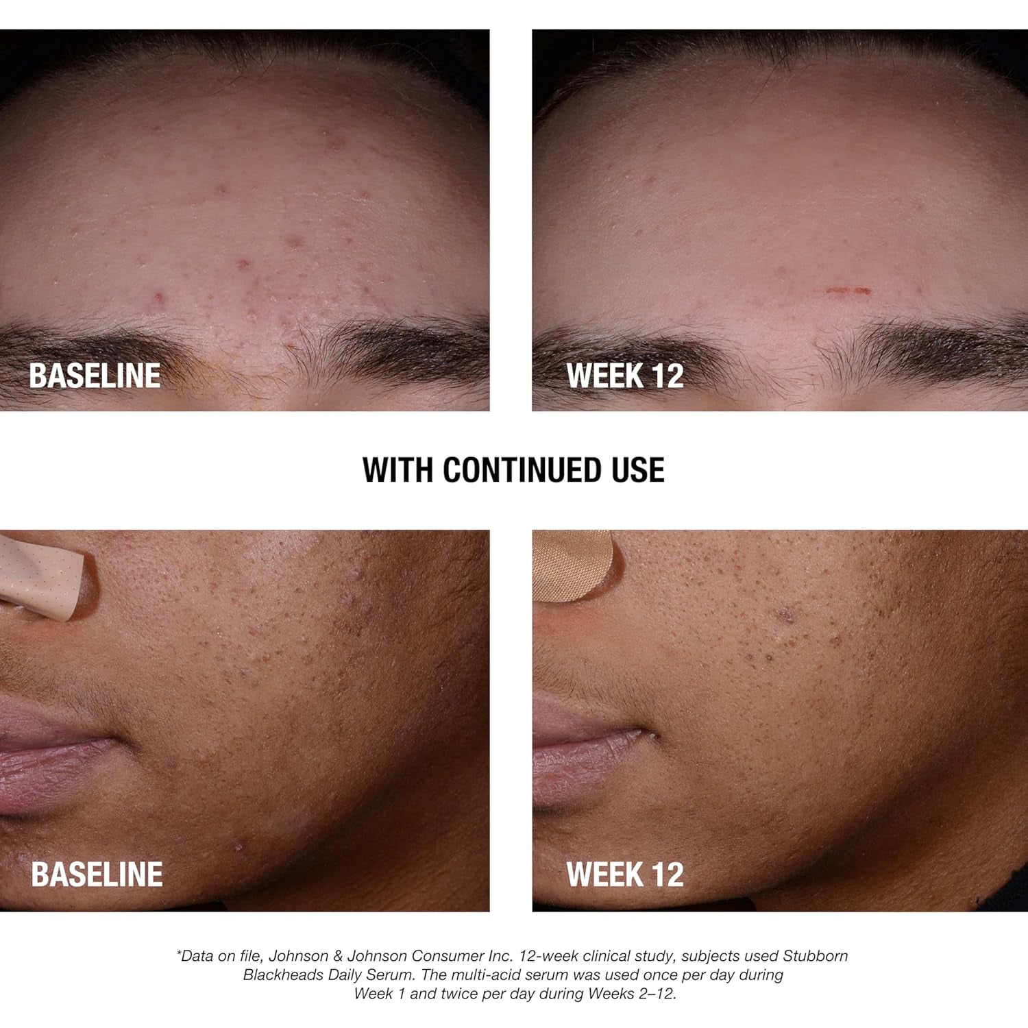 Stubborn Blackheads Daily Acne Facial Serum with Salicylic, Glycolic, Polyhydroxy & Mandelic Acids, Oil-Free Face Serum for Acne-Prone Skin to Help Clear Clogged Pores, 1 Fl. Oz